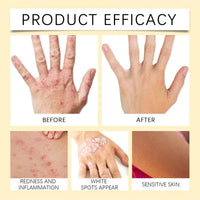 Vitigo Bee Venom Treatment Cream | Natural Skin Repair Hydration Relief Anti-Irritation